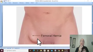 Hernia in Arabic 17 ( Femoral hernia , part 2  ) , by Dr. Wahdan