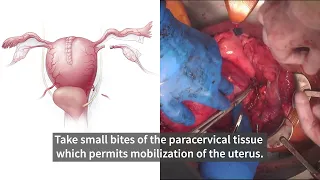 Obstetrical Hemorrhage from Placenta Accreta: Saving Lives with Cesarean Hysterectomy | Stanford