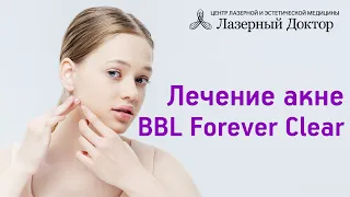 Лечение акне. BBL Forever Clear.