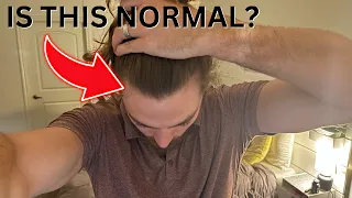 AM I BALDING? (Difference Between Hair Loss & Shedding)