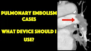 Pulmonary Embolism Thrombectomy Devices: The Basics