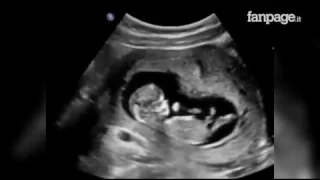 Il bimbo tira calci nella pancia della mamma: l'emozionante ecografia del feto