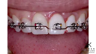 ORTHODONTIC TIPS #Shorts