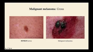 Overview of Skin Cancer - CRASH! Medical Review Series