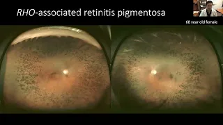 Lecture: The Clinical Examination & Management of Inherited Retinal Diseases