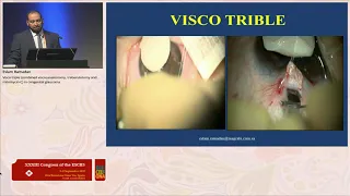 VISCO TRIPLE  TO MANAGE  CONGENITAL GLAUCOMA   ESCRS 2015 PRESENTATION