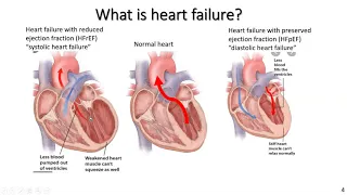 Chronic heart failure and exercise for exercise professionals: part 1
