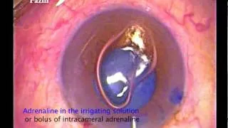 miotic pupil  - intra cameral adrenaline