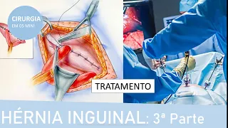 Como tratar a hérnia inguinal? Respondendo perguntas! | Fernando Eyer