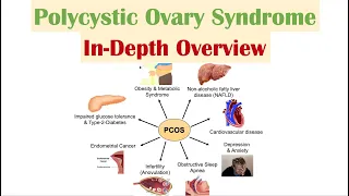 Polycystic Ovary Syndrome (PCOS) | Overview of Associated Conditions, Diagnosis & Treatments