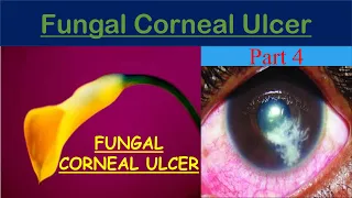 Fungal Corneal Ulcer (keratitis part 4)