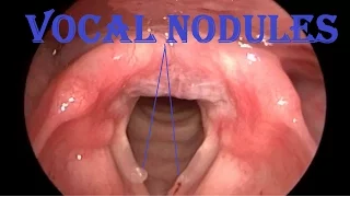 Video Laryngoscopy : Vocal Nodules / Singer's Nodes / Screamer's Nodes