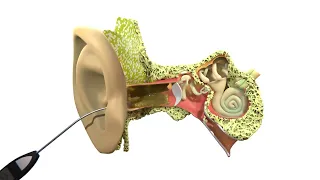 Earwax Microsuction 3D