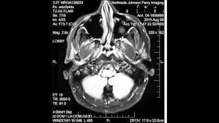 MRI Aug 2015 - petrous apex