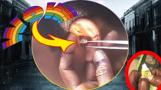 Huge Earwax Removed from Ear Drum / Most Satisfying Ear Cleaning with Relaxing Rain Sounds