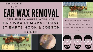 EAR WAX REMOVAL USING ST BARTS HOOK & JOBSON HORNE - EP397