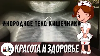 Инородное тело кишечника