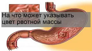 На что может указывать цвет рвотной массы