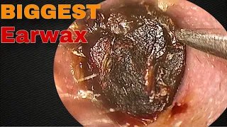BIGGEST Earwax, Difficult Removal, EP 10 | Doctor Anh