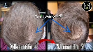 Oral Minoxidil (Loniten) Results in 7 Months