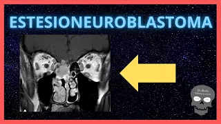 ESTESIONEUROBLASTOMA 👉Hallazgos radiológicos