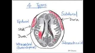 Intracranial Bleed - Part 1