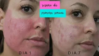 RECUPERAÇÃO LASER FACIAL