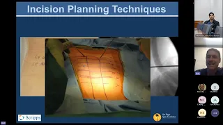 Surgical Approach for Percutaneous Screw Placement presented by Robert K. Eastlack, MD