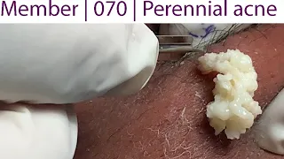 Acne Treatment Huong Da Nang# 070 |  Perennial acne