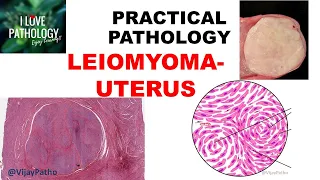 LEIOMYOMA UTERUS: etiology, Clinical features, Gross & Microscopy