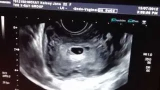 6 week pregnancy ultrasound. SMALL SAC?