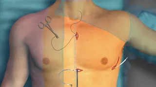 S-ICD Implantation: 3-Incision Technique with EMBLEM 3501 Electrode
