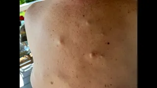 EXTREME CYST & PIMPLE EXPLOSION UNDER PRESSURE