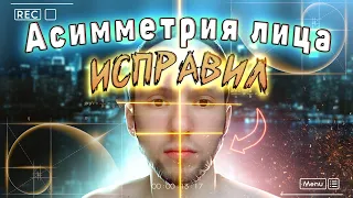 Как исправить асимметрию лица? Мой опыт, как я убрал асимметрию лица?