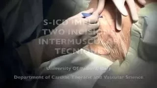 S-ICD Implant - Intermuscular Two-Incisions S-ICD Implantation Technique - Federico Migliore