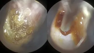 113 - Fizzy & Bubbly Ear Wax Removal using WAXscope®️