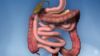 Biliopancreatic diversion with duodenal switch