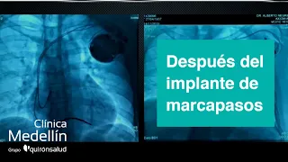 Deterioro de la Función Ventricular después del implante de marcapasos