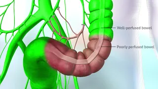 3D Animation Visualization of a Colectomy using ICG