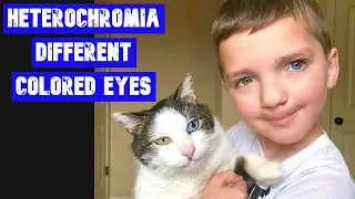 Heterochromia Different Colored Eyes