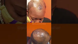 Alopecia Hair braiding Transformation 2