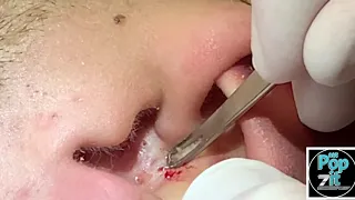Ear extractions part 1. Blackheads, whiteheads, milia, deep in the ear and on the face. MrPopZit
