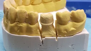 Full metal crown lost wax technique