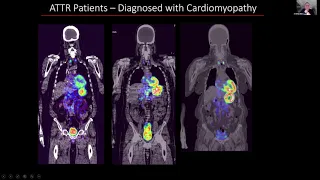 ATTR Amyloid Imaging Update