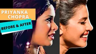 PRIYANKA CHOPRA PLASTIC SURGERY