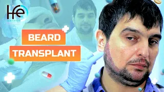 Beard and moustache transplant