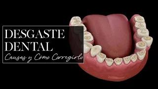 Desgaste Dental: causas y cómo corregirlo