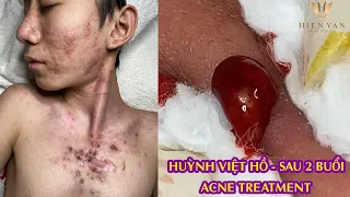Cystic Acne TreatmentI Điều trị mụn miễn phí Hiền Vân Spa I Huỳnh Việt Hồ sau 2 buổi I 509