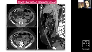 Find The Mesh - Dr. Jignesh Gandhi #ANZAWR