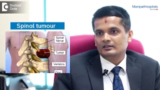 Most Common Spinal Tumours And Treatments | Spinal Tumours Treatment | Manipal Hospitals